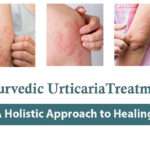 Ayurvedic Urticaria Treatment: A Holistic Approach to Healing