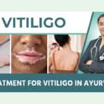 How to Choose the Right Vitiligo Treatment in Ayurveda