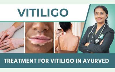 How to Choose the Right Vitiligo Treatment in Ayurveda